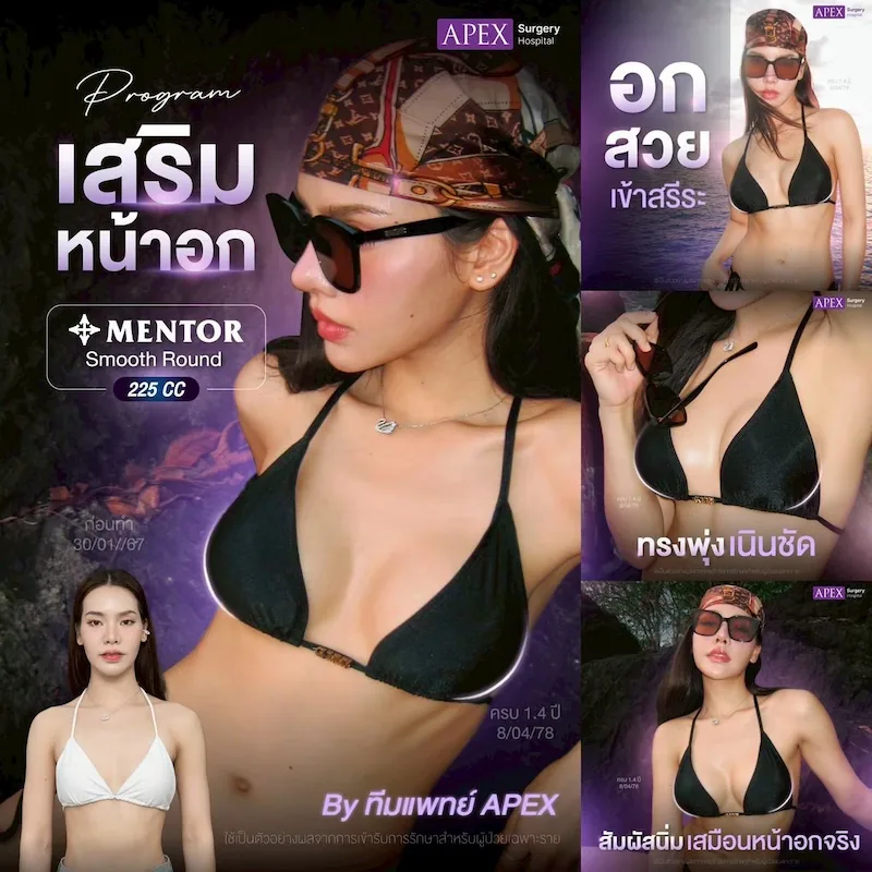 รีวิว เสริมหน้าอก