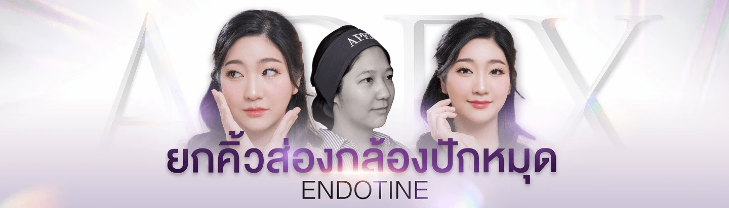 ยกคิ้ว ส่องกล้องปักหมุด Endotine