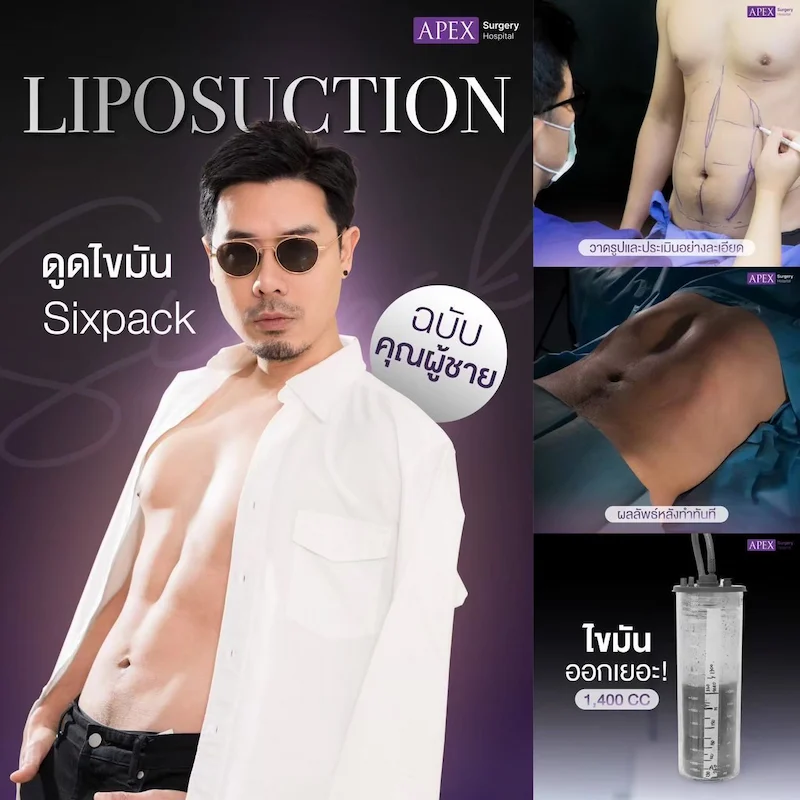 รีวิว ดูดไขมัน