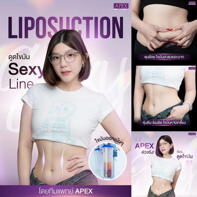 รีวิว ดูดไขมัน