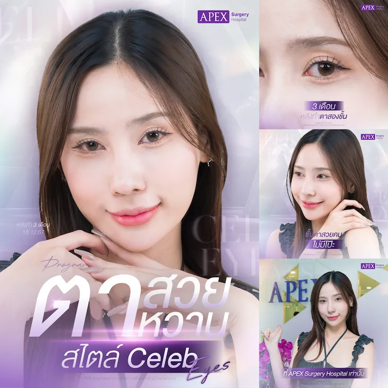 รีวิวทำตาสองชั้น Celeb eyes