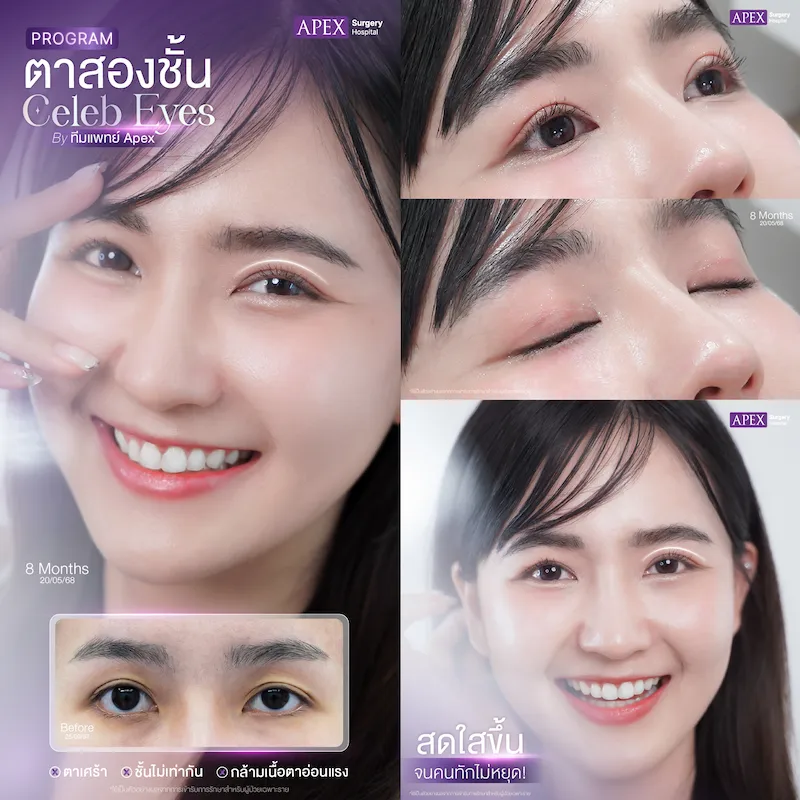 รีวิวทำตาสองชั้น Celeb eyes