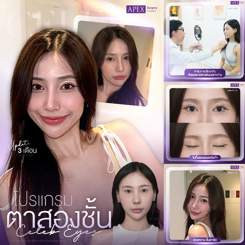 รีวิวทำตาสองชั้น Celeb eyes