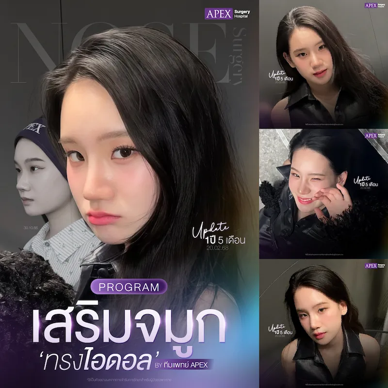 รีวิว เสริมจมูก