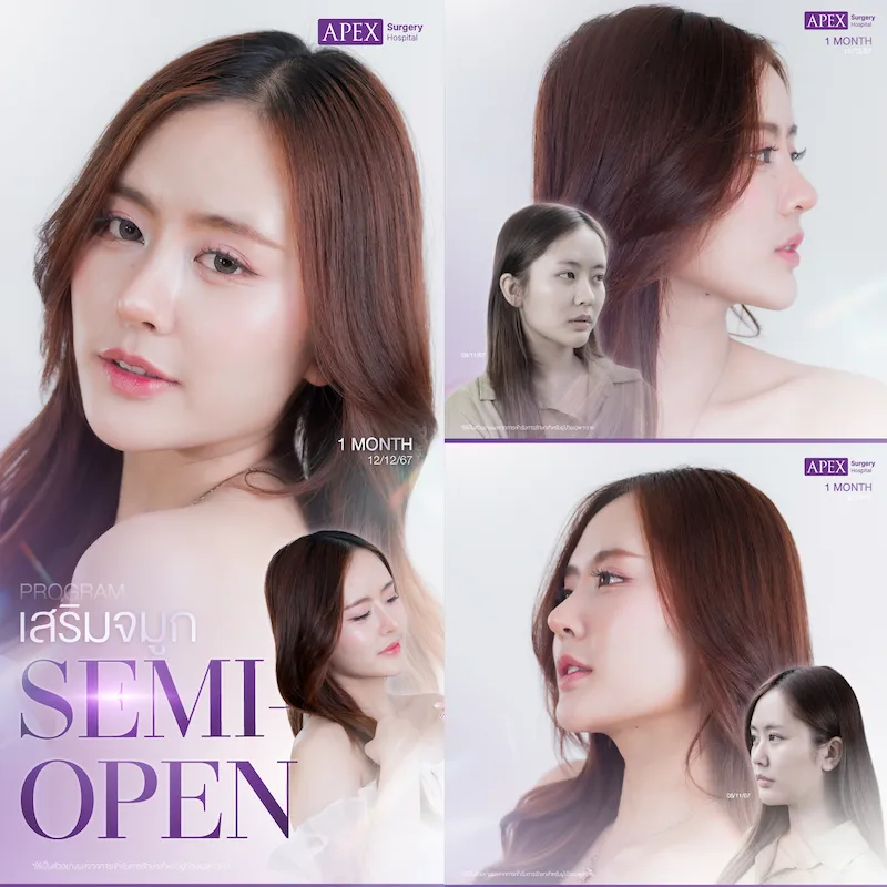 รีวิว เสริมจมูก