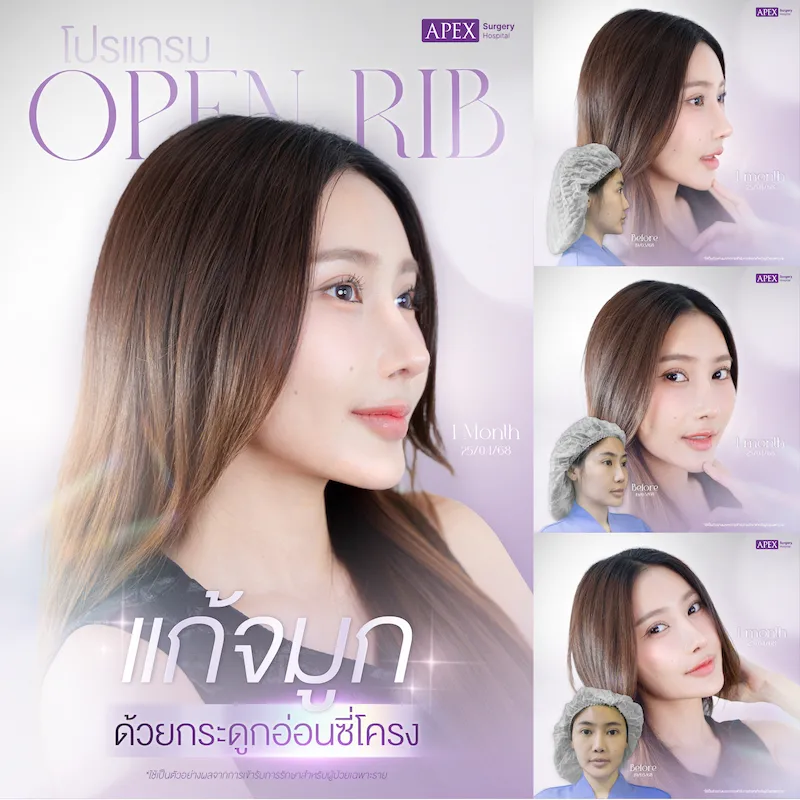 รีวิว เสริมจมูก