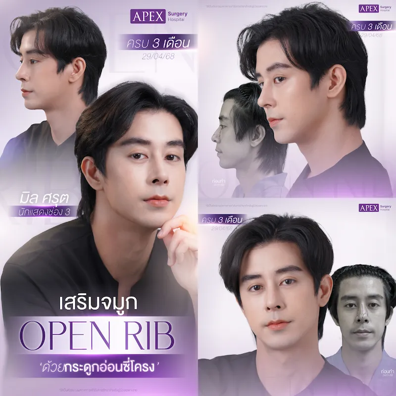 รีวิว เสริมจมูก