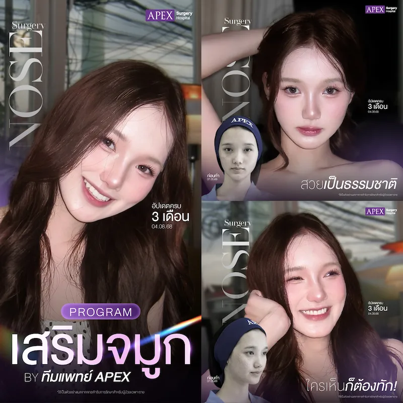 รีวิว เสริมจมูก