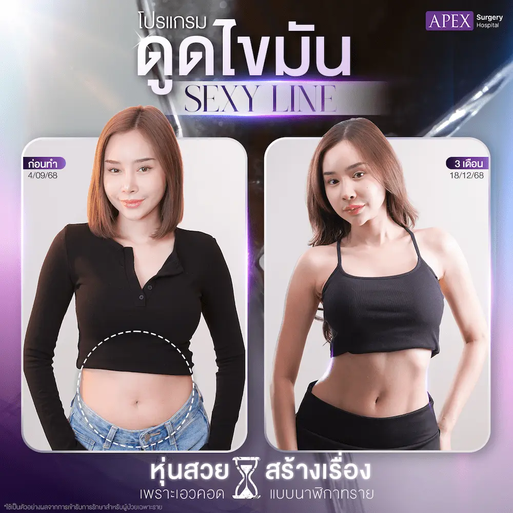 ดูดไขมันฟ้าบาร์บี้_BA_1ต่อ1