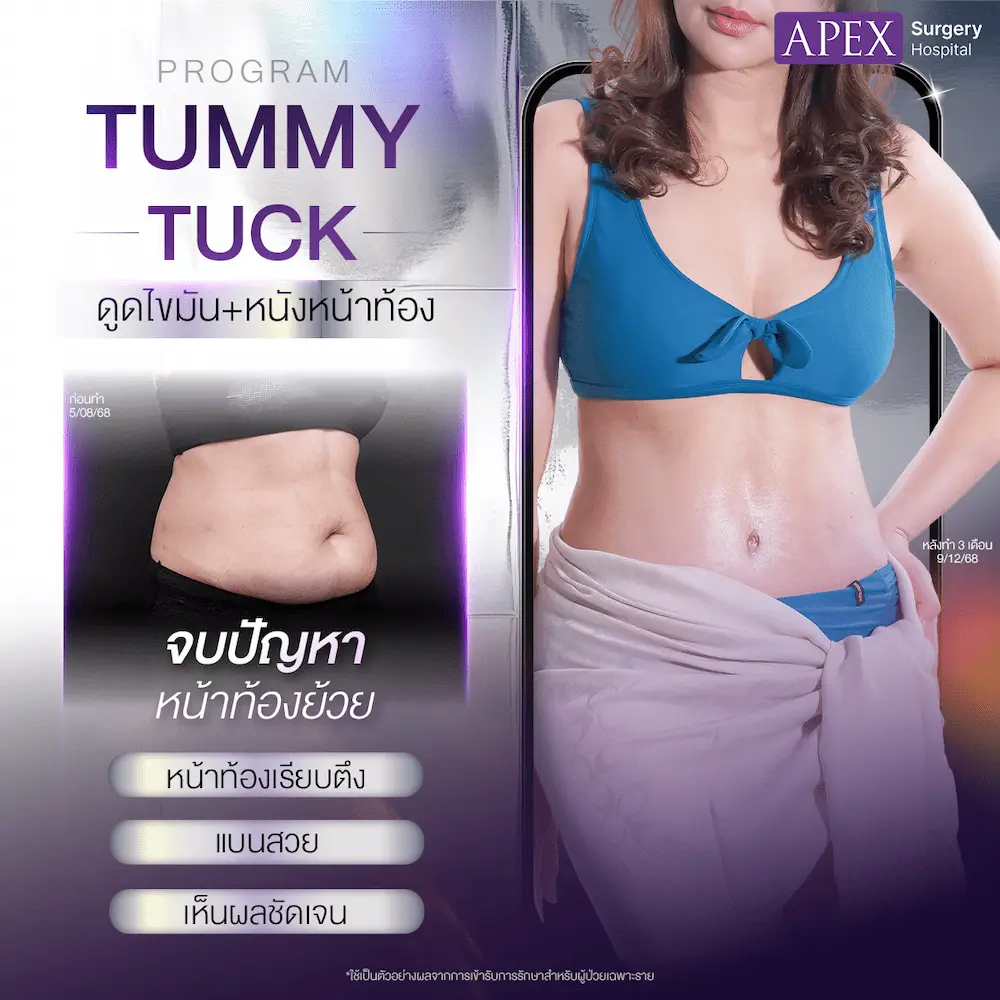 พี่แป๋มดูดไขมัน+ตัดหนังท้อง3M_1ต่อ1