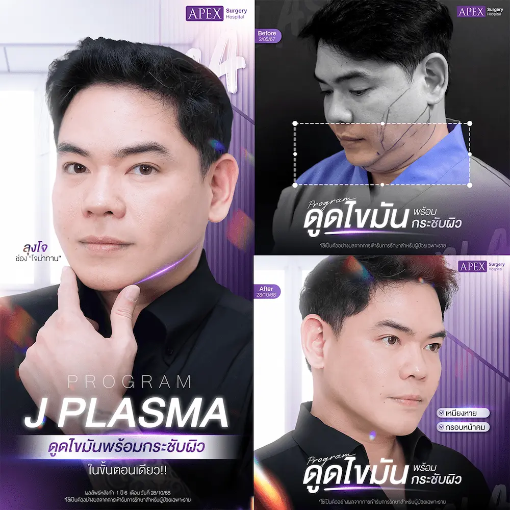 รวม-JPlasmaดูดไขมันเหนียง